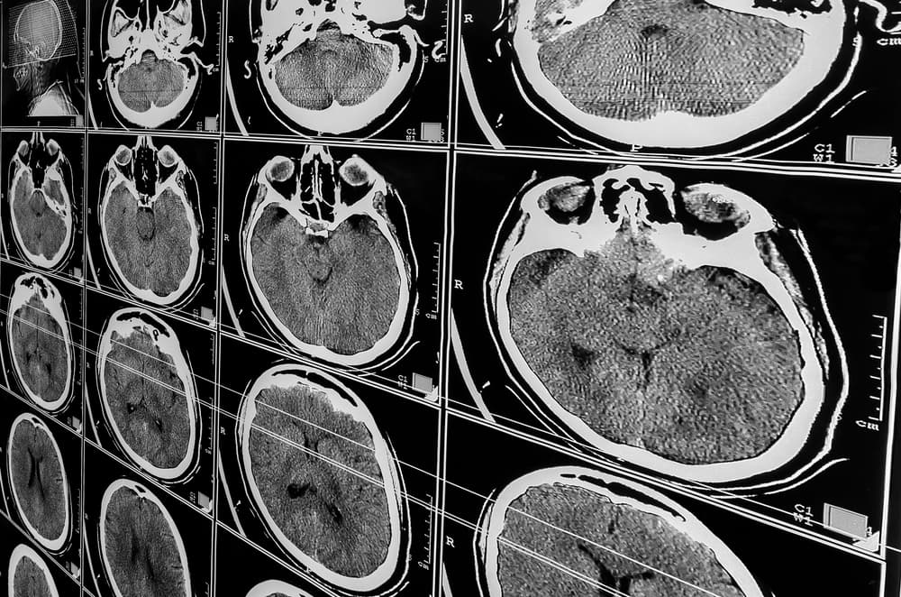 Daño cerebral traumático