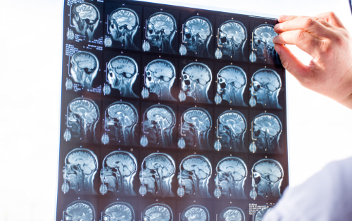 Doctor holding up an MRI film of brain scans to the light